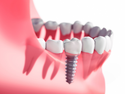 Dental-Implants-South-Carolina