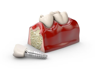 Dental Implants South Carolina