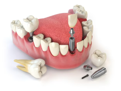 dental implant cost massachusetts