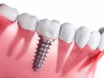 dental implants south carolina