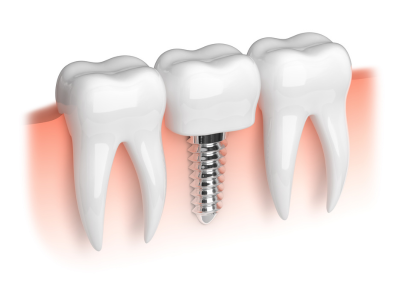 dental implants south carolina