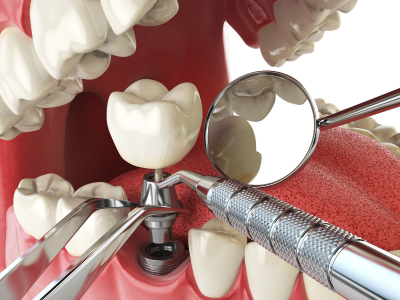 Tooth Extraction Woodland Hills
